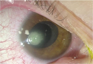 Заболевания роговицы глаза: разновидности, симптомы, лечение