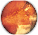 Лечение отслоения сетчатки глаза в курске