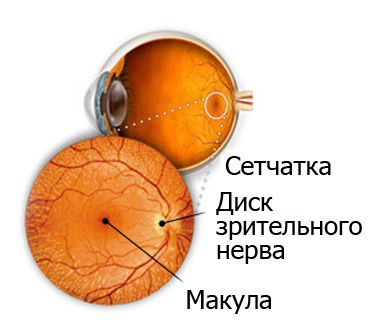 Лечение отслоения сетчатки глаза в курске